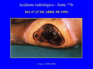 DIA 67 (27 DE ABRIL DE 1999) Acidente radiológico - fonte  192 Ir  ( Fonte - CDTN 2009) 