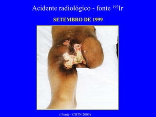 SETEMBRO DE 1999 Acidente radiológico - fonte  192 Ir  ( Fonte - CDTN 2009) 