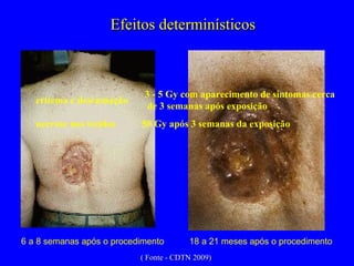 18 a 21 meses após o procedimento 6 a 8 semanas após o procedimento Efeitos determinísticos eritema e descamação necrose nos tecidos 50 Gy após 3 semanas da exposição 3 - 5 Gy com aparecimento de sintomas cerca de 3 semanas após exposição ( Fonte - CDTN 2009) 
