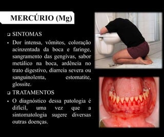  SINTOMAS
 Dor intensa, vômitos, coloração
acinzentada da boca e faringe,
sangramento das gengivas, sabor
metálico na boca, ardência no
trato digestivo, diarreia severa ou
sanguinolenta, estomatite,
glossite.
 TRATAMENTOS
 O diagnóstico dessa patologia é
difícil, uma vez que a
sintomatologia sugere diversas
outras doenças.
MERCÚRIO (Mg)
 