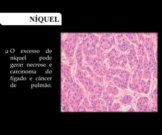  O excesso de
níquel pode
gerar necrose e
carcinoma do
fígado e câncer
de pulmão.
NÍQUEL
 
