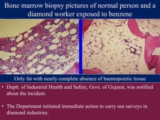 Bone marrow biopsy pictures of normal person and a
diamond worker exposed to benzene
Only fat with nearly complete absence of haemopoietic tissue
• Deptt. of Industrial Health and Safety, Govt. of Gujarat, was notified
about the incident.
• The Department initiated immediate action to carry out surveys in
diamond industries.
 