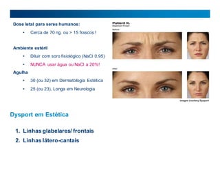 Dose letal para seres humanos:
• Cerca de 70 ng, ou > 15 frascos !
Ambiente estéril
• Diluir com soro fisiológico (NaCl 0,95)
• NUNCA usar água ou NaCl a 20%!
Agulha
• 30 (ou 32) em Dermatologia Estética
• 25 (ou 23), Longa em Neurologia
Dysport em Estética
1. Linhas glabelares/ frontais
2. Linhas látero-cantais
 