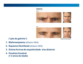 (“pés de galinha”)
1. Blefaroespasmo (eficácia >90%)
2. Espasmo Hemifacial (eficácia >90%)
3. Outras formasde espasticidade e/ou distonia
4. Paralisia Cerebral
(> 2 anos de idade)
 