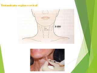 Tratamiento región cervical
3-10U
 