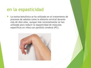 en la espasticidad
 La toxina botulínica se ha utilizado en el tratamiento de
procesos de adultos como la distonía cervical durante
más de diez años, aunque más recientemente se han
utilizado para reducir la espasticidad de músculos
específicos en niños con parálisis cerebral (PC).
 