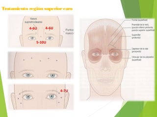 Tratamiento región superiorcara
4-6U 4-6U
5-10U
4-7U
 