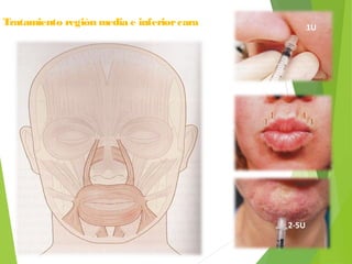 Tratamiento región media e inferiorcara
2-5U
1U
 