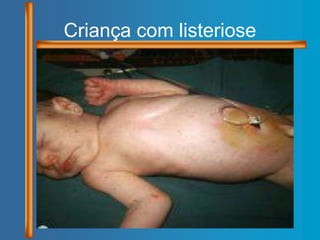 Criança com listeriose
 