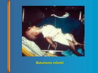 Botulismo infantil
 