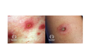 toxin mediated dermatological disease.pptx