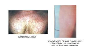 Pinprick Sandpaper Rash toxin mediated dermatological disease.pptx