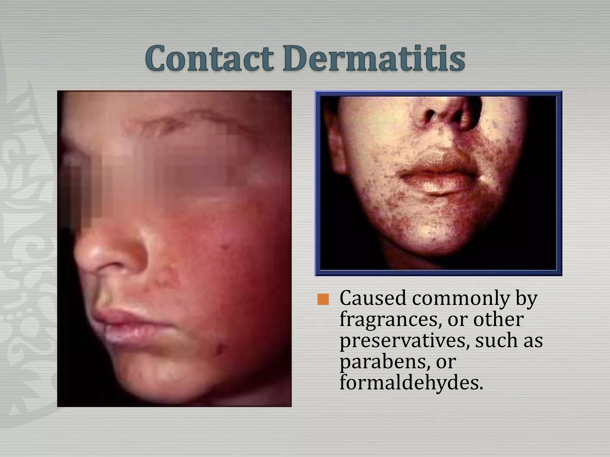 Contact DermatitisCaused commonly by fragrances, or other preservatives, such as parabens, or formaldehydes.