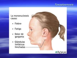 Toxoplasmosis Slide 11