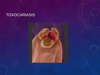 TOXOCARIASIS
 