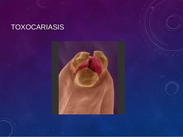 Toxocariasis