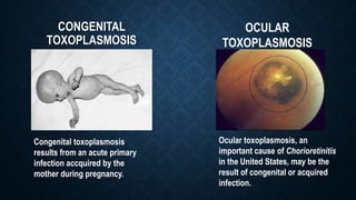 CONGENITAL
TOXOPLASMOSIS
Congenital toxoplasmosis
results from an acute primary
infection accquired by the
mother during pregnancy.
OCULAR
TOXOPLASMOSIS
Ocular toxoplasmosis, an
important cause of Chorioretinitis
in the United States, may be the
result of congenital or acquired
infection.
 