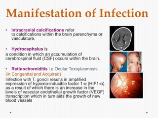 Manifestation of Infection
• Intracranial calcifications refer
to calcifications within the brain parenchyma or
vasculature.
• Hydrocephalus is
a condition in which an accumulation of
cerebrospinal fluid (CSF) occurs within the brain.
• Retinochoroiditis i.e Ocular Toxoplasmosis
(in Congenital and Acquired)
Infection with T. gondii results in amplified
expression of hypoxia-inducible factor 1-α (HIF1-α),
as a result of which there is an increase in the
levels of vascular endothelial growth factor (VEGF)
transcription which in turn aids the growth of new
blood vessels
 