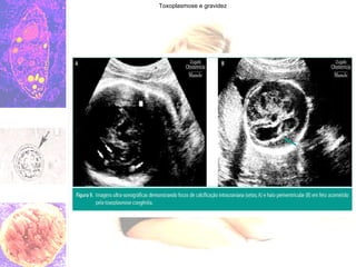 Toxoplasmose e gravidez 