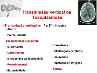 Transmissão vertical     1º e 2º trimestre Aborto Prematuridade Toxoplasmose Congênita Microftalmia Coriorretinite Microcefalia c/s hidrocefalia Retardo mental Espasticidade Convulsões Calcificações cerebrais Pneumonite Hepatoesplenomegalia Surdez Transmissão vertical da  Toxoplasmose 