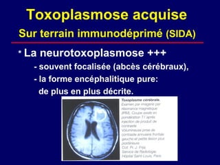 Toxoplasmose acquise
Sur terrain immunodéprimé (SIDA)
* La   neurotoxoplasmose +++
   - souvent focalisée (abcès cérébraux),
   - la forme encéphalitique pure:
     de plus en plus décrite.
 