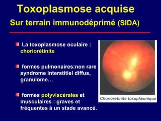 Toxoplasmose acquise
Sur terrain immunodéprimé (SIDA)

   La toxoplasmose oculaire :
  choriorétinite

   formes pulmonaires:non rare
  syndrome interstitiel diffus,
  granulome…

   formes polyviscérales et
  musculaires : graves et
  fréquentes à un stade avancé.
 