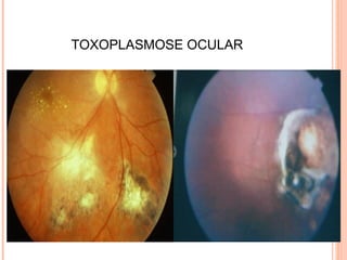 TOXOPLASMOSE OCULAR

 