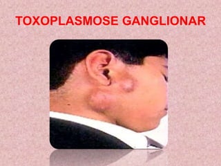TOXOPLASMOSE GANGLIONAR
 