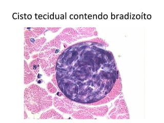 Cisto tecidual contendo bradizoíto
 