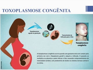 TOXOPLASMOSE CONGÊNITA
 