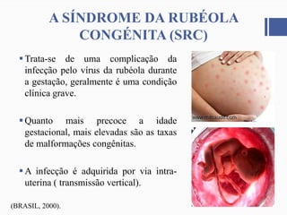 A SÍNDROME DA RUBÉOLA
CONGÉNITA (SRC)
Trata-se de uma complicação da
infecção pelo vírus da rubéola durante
a gestação, geralmente é uma condição
clínica grave.
Quanto mais precoce a idade
gestacional, mais elevadas são as taxas
de malformações congênitas.
A infecção é adquirida por via intra-
uterina ( transmissão vertical).
(BRASIL, 2000).
 
