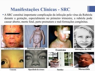Manifestações Clínicas - SRC
 A SRC constitui importante complicação da infecção pelo vírus da Rubéola
durante a gestação, especialmente no primeiro trimestre, a rubéola pode
causar aborto, morte fetal, parto prematuro e mal-formações congênitas.
Hepatoesplenomegalia
Surdez
Alterações do SNCExantema
Microcefalia
 