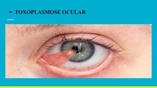 ➢ TOXOPLASMOSE OCULAR
 