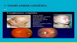➢ TOXOPLASMOSE CONGÊNITA
 