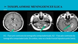 A1 – Fase pré-contraste da tomografia computadorizada. A2 – Fase pós-contraste da
tomografia computadorizada. Em ambas, nota-se a lesão frontal hipoatenuante (seta),
➢ TOXOPLASMOSE MENINGOENCEFÁLICA
 