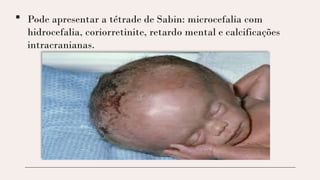  Pode apresentar a tétrade de Sabin: microcefalia com
hidrocefalia, coriorretinite, retardo mental e calcificações
intracranianas.
 