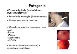 Patogenia
Ø Forma Adquirida (em indivíduos
imunocompetentes):
ü  Período de incubação (1 a 4 semanas)
ü  Normalmente assintomática
ü  Quando sintomática (em menos de 1% dos
casos):
•  Febre
•  Mialgia
•  Adenopatia
•  Cefaléia
ü  Lesão ocular (Coriorretinite) –
normalmente unilateral
 