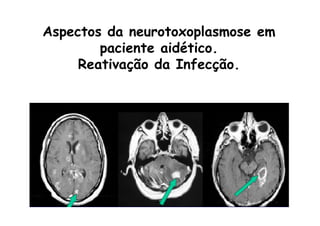 Aspectos da neurotoxoplasmose em
paciente aidético.
Reativação da Infecção.
 