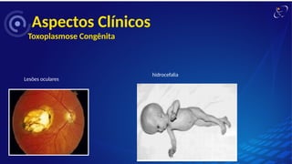 Aspectos Clínicos
Toxoplasmose Congênita
Lesões oculares
hidrocefalia
 