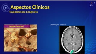 Aspectos Clínicos
Toxoplasmose Congênita
Calcificações cerebrais
 