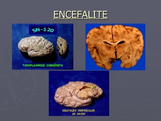 ENCEFALITE 