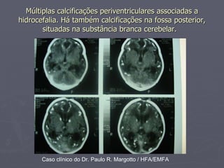 Múltiplas calcificações periventriculares associadas a hidrocefalia. Há também calcificações na fossa posterior, situadas na substância branca cerebelar.   Caso clínico do Dr. Paulo R. Margotto / HFA/EMFA 