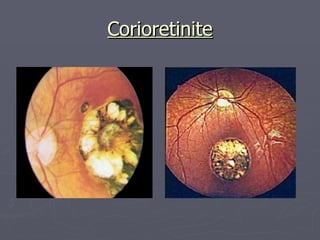 Corioretinite 