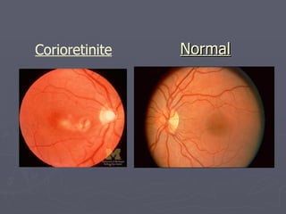 Normal Corioretinite 