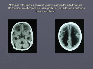 Múltiplas calcificações periventriculares associadas a hidrocefalia.  Há também calcificações na fossa posterior, situadas na substância branca cerebelar.   