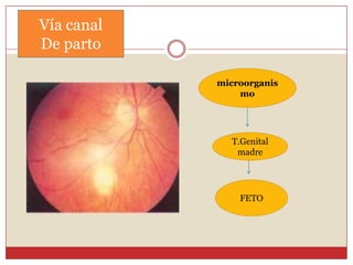 MicoticosInfeccióncongénitasignossíntomasRECIEN NACIDO