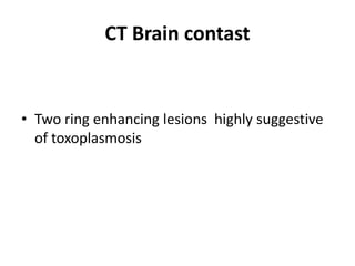 CT Brain contast


• Two ring enhancing lesions highly suggestive
  of toxoplasmosis
 