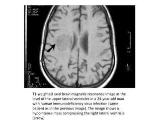 T1-weighted axial brain magnetic resonance image at the
level of the upper lateral ventricles in a 24-year-old man
with human immunodeficiency virus infection (same
patient as in the previous image). The image shows a
hypointense mass compressing the right lateral ventricle
(arrow)
 