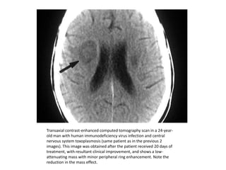 Transaxial contrast-enhanced computed tomography scan in a 24-year-
old man with human immunodeficiency virus infection and central
nervous system toxoplasmosis (same patient as in the previous 2
images). This image was obtained after the patient received 20 days of
treatment, with resultant clinical improvement, and shows a low-
attenuating mass with minor peripheral ring enhancement. Note the
reduction in the mass effect.
 