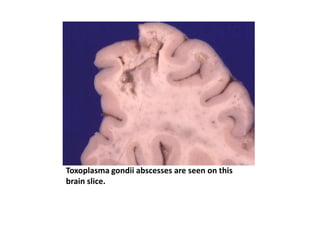 Toxoplasma gondii abscesses are seen on this
brain slice.
 